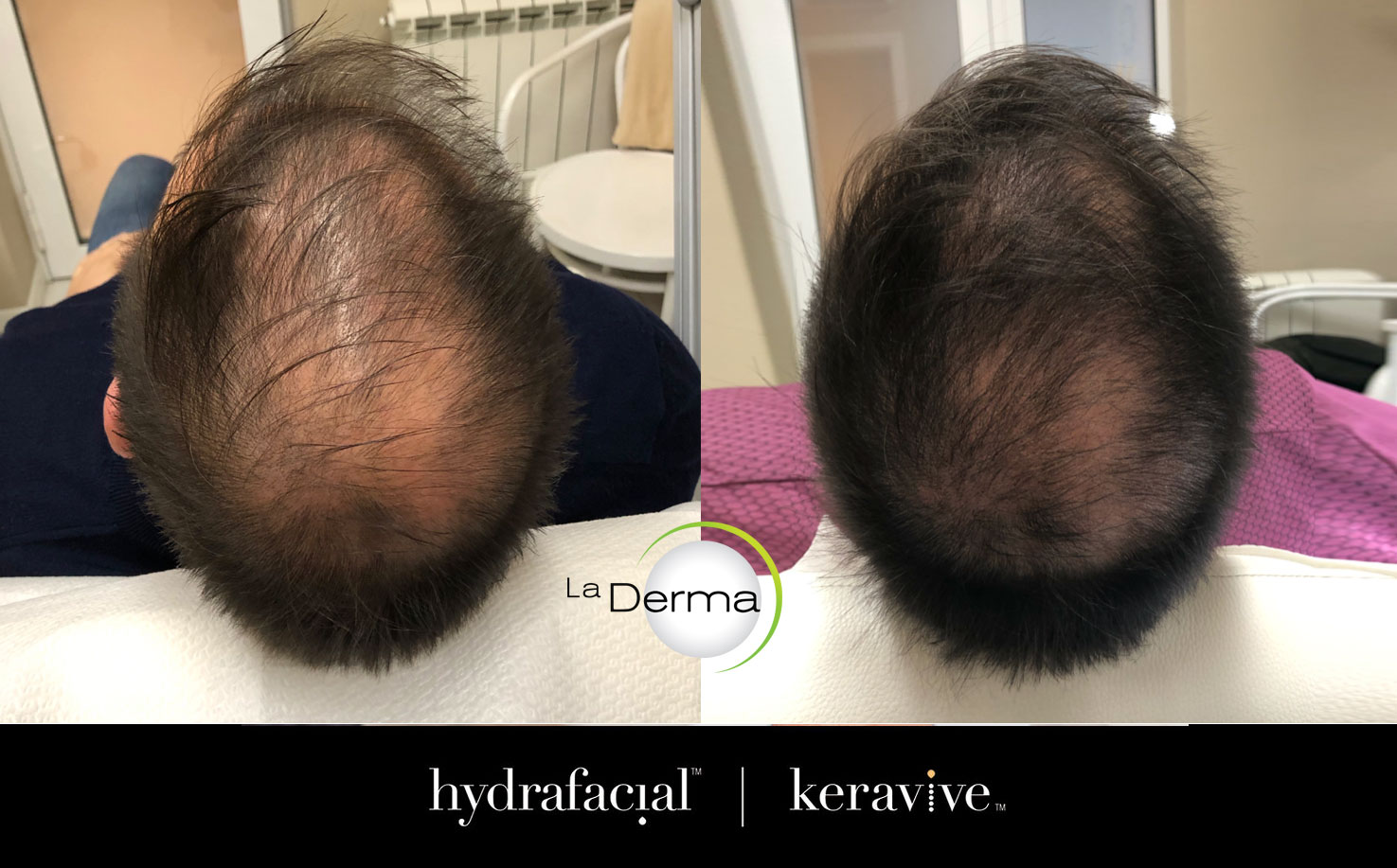 Hydrafacial® Keravive™ - Pre i posle primene tretmana - Kosa na temenu glave
