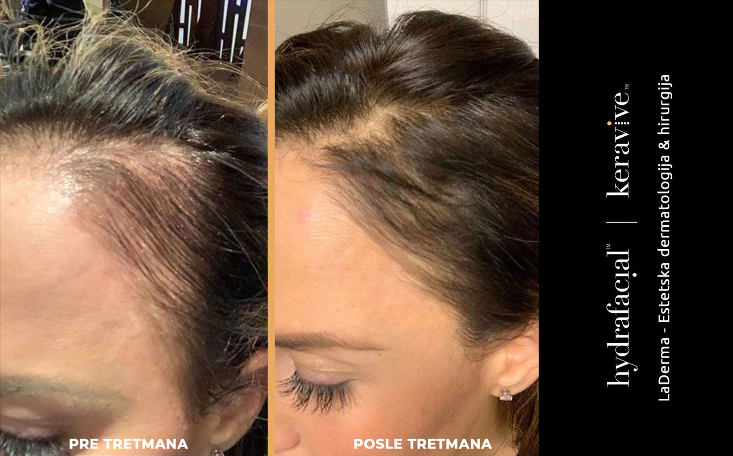 Hydrafacial® Keravive™ - Pre i posle - Gušća kosa na zaliscima posle tretmana